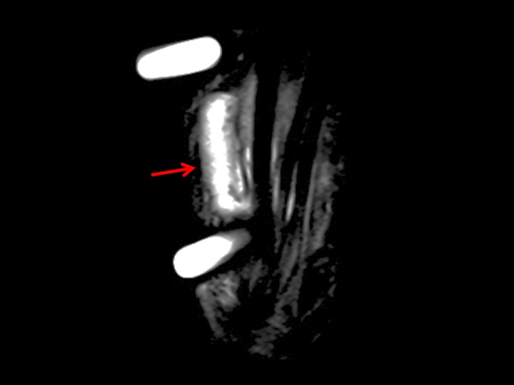 Figure 4 for case 4th extensor compartment tendinosis and stenosing tenosynovitis